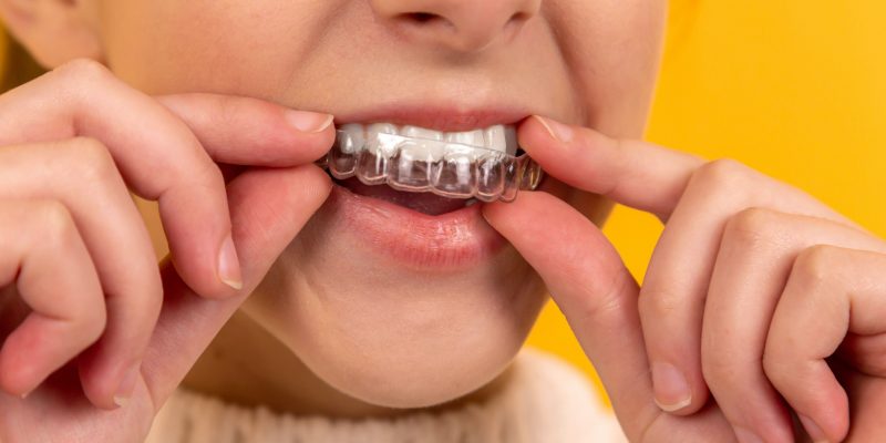 Teeth Invisalign