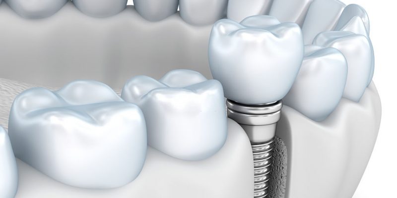 Tips To Increase The Longevity Of Your Dental Implants