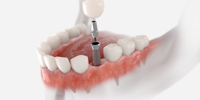 How To Prepare Yourself for a Dental Implant Surgery