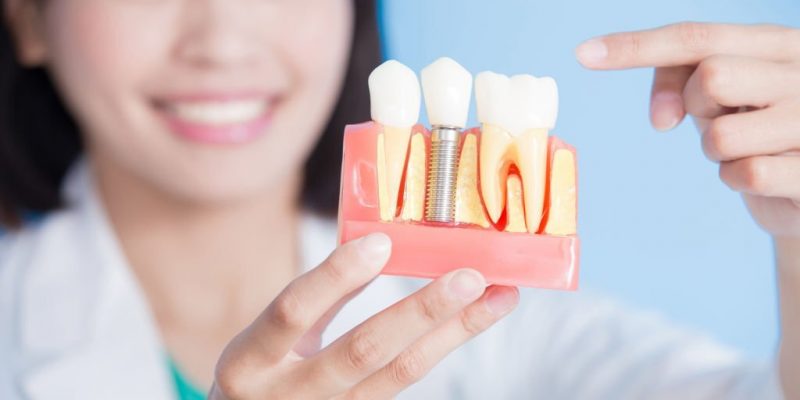 Problems With Dental Implants