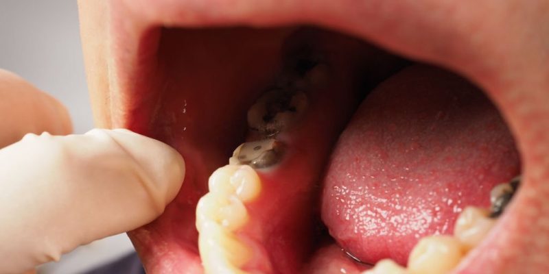 Understanding Root Canal With Crown Treatment