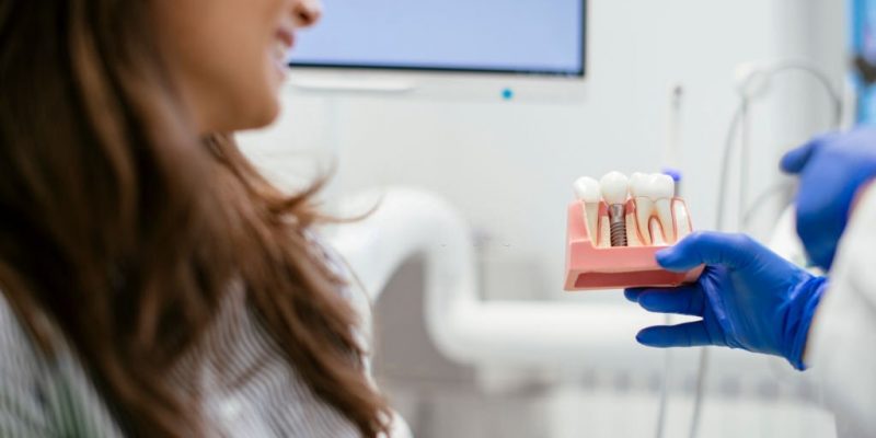 Dental Implants Procedure