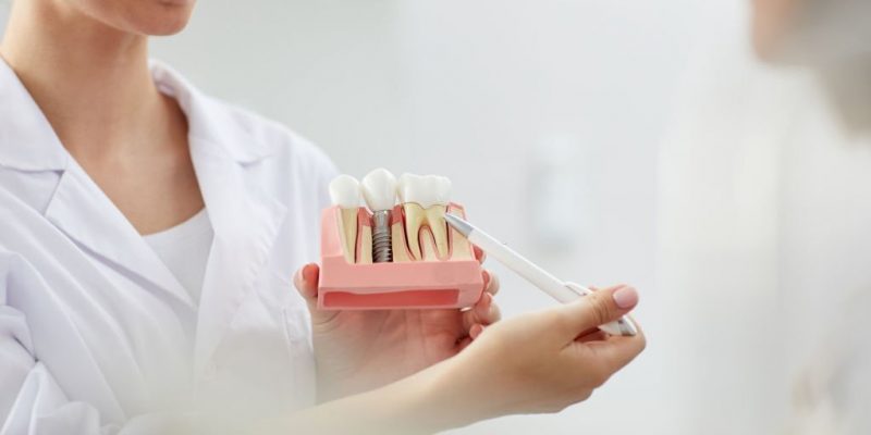 Dental Implant Procedure: Everything You Need to Know