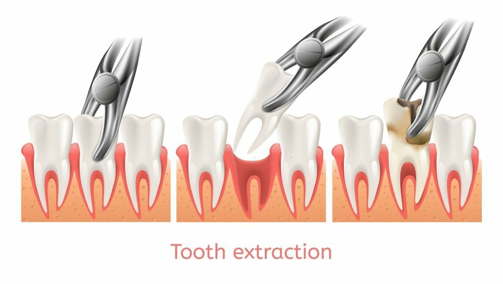 Tooth extraction process