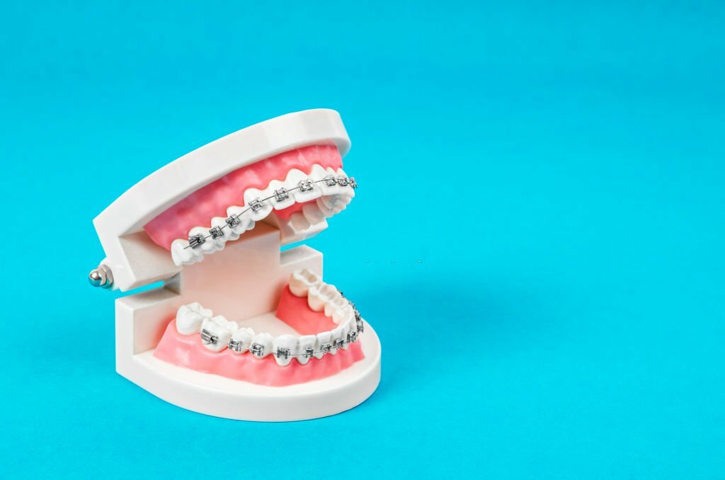 How To Choose The Right Orthodontic Treatment In Gallup, NM
