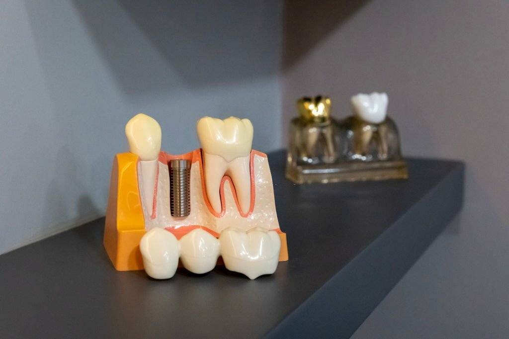Implants Vs. Dentures: What's The difference?