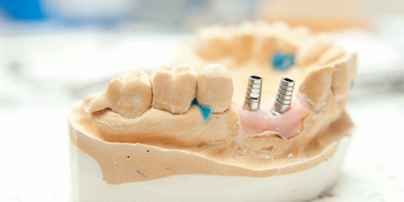 Implants Vs. Dentures: What's The difference?_FI