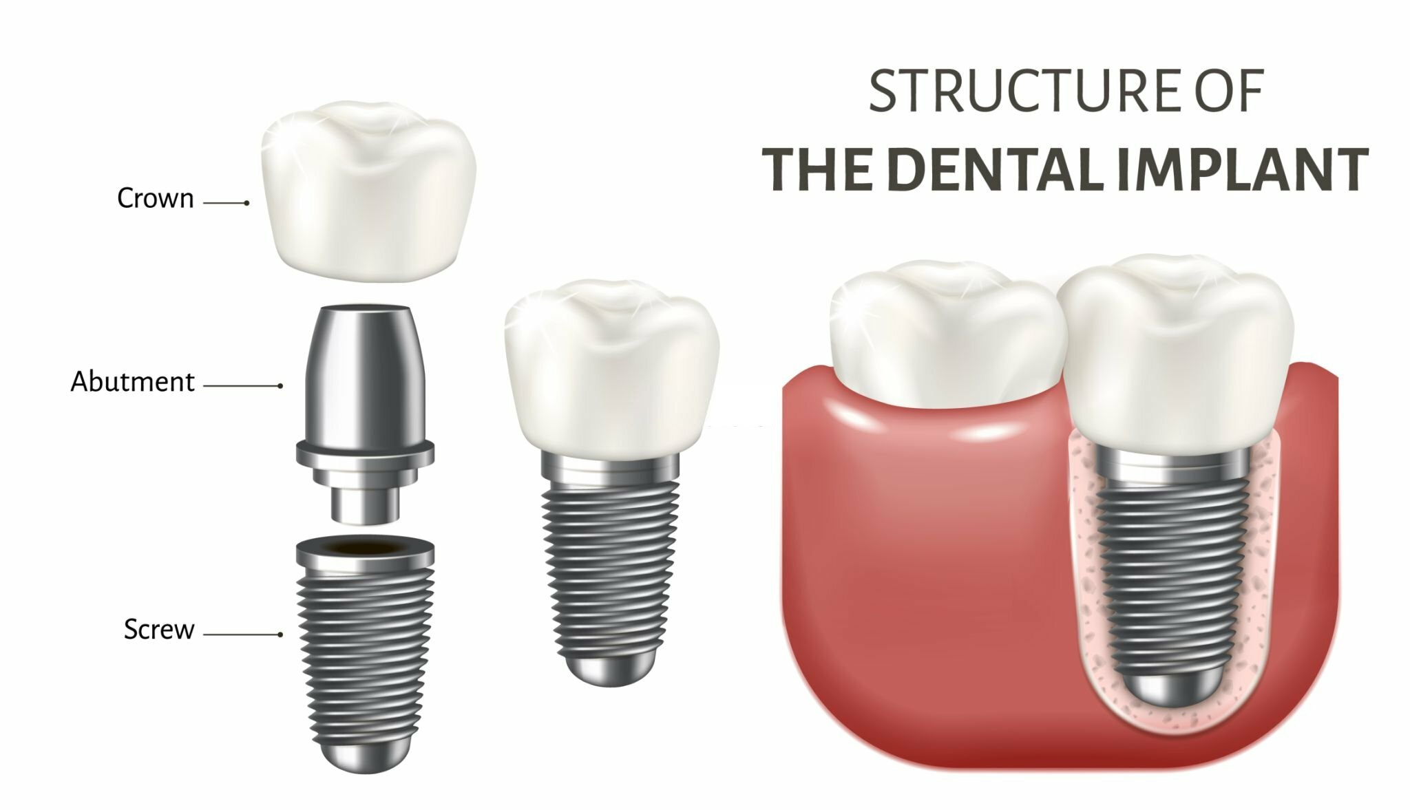 The Impact of Mexico's Dental Implants on Oral Health_1