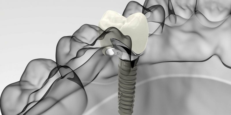 The Impact of Mexico's Dental Implants on Oral Health_FI