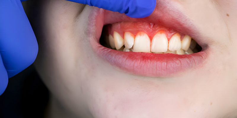 From Symptoms to Solutions: Navigating Gum Disease Easily_FI