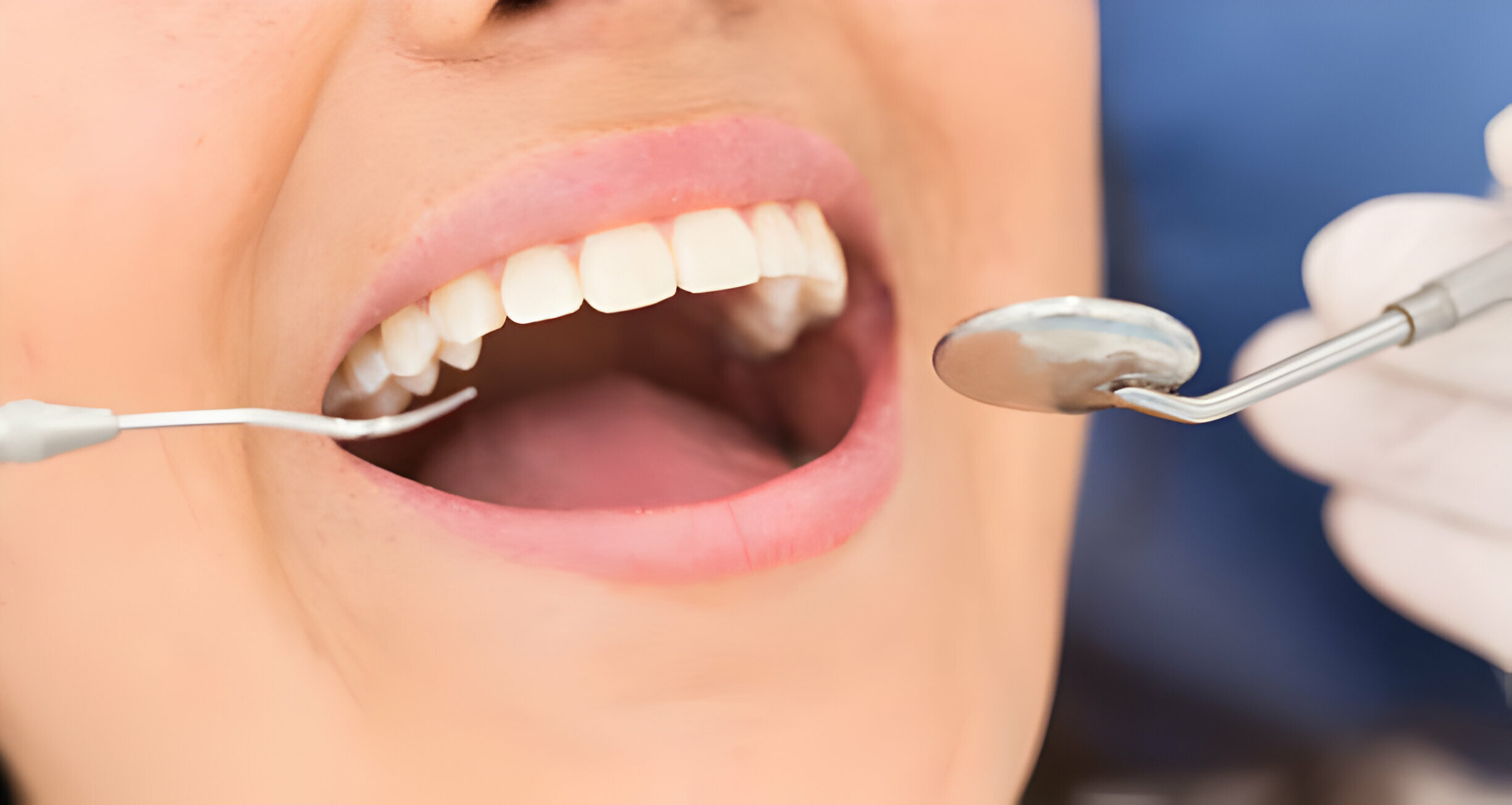 Understanding The Different Stages of the Root Canal Treatment Process_3