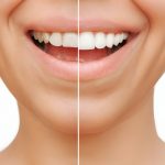 Unlocking the Secrets of Dental Crowns: A Comprehensive Guide_FI