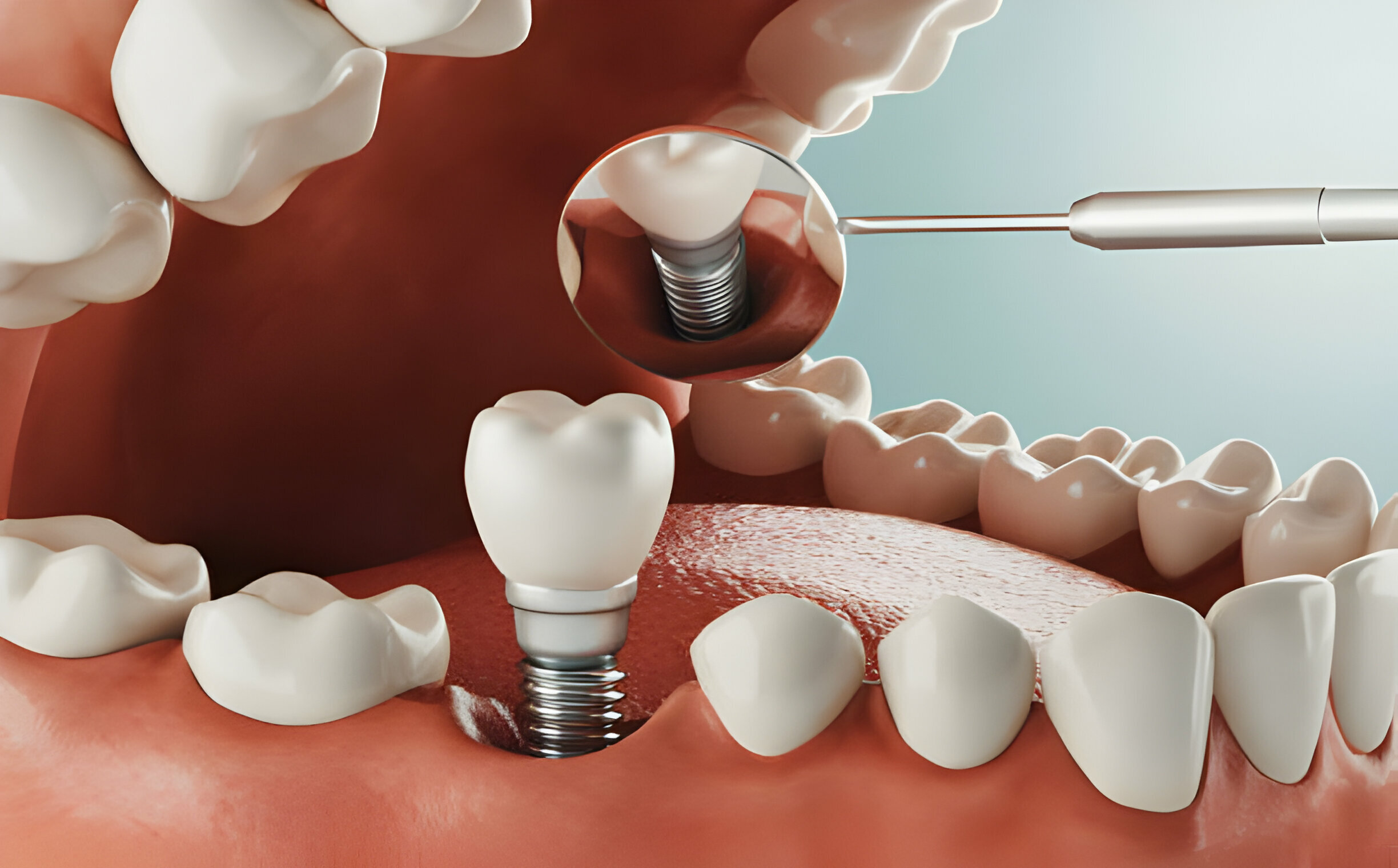 Grants For Teeth Implants: Affordable Options For A Radiant Smile_3
