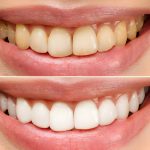 Achieve a Brighter Smile: The Ultimate Guide to Teeth Whitening_FI