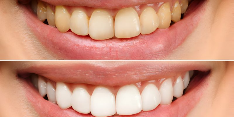Achieve a Brighter Smile: The Ultimate Guide to Teeth Whitening_FI