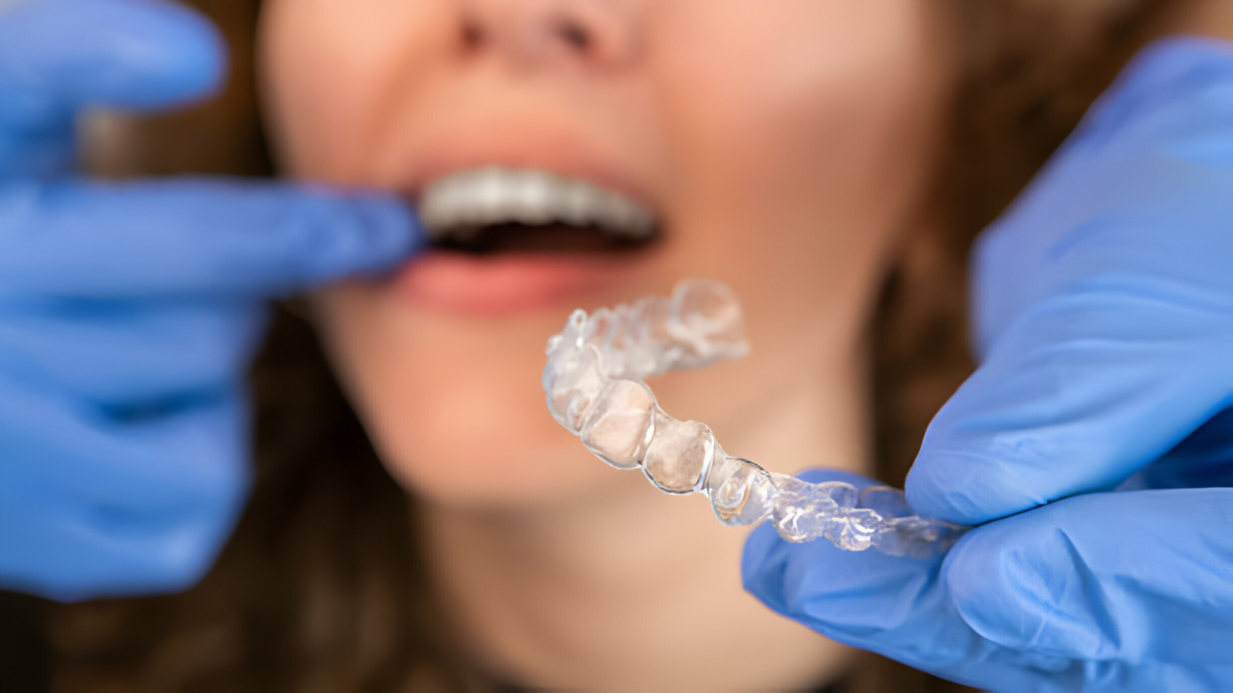 5 Signs You’re A Good Candidate For Invisalign Braces_2
