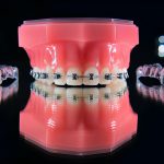 5 Signs You’re A Good Candidate For Invisalign Braces_FI