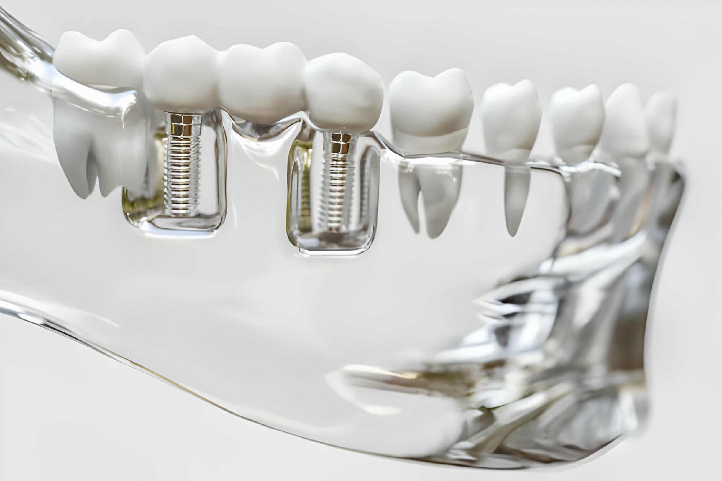 The Ultimate Guide: Post-Root Canal Dos and Don'ts_1