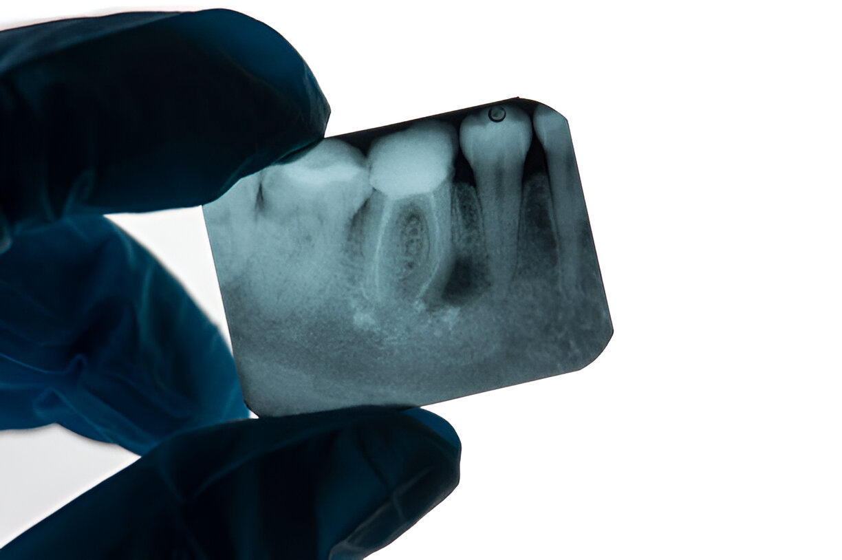 Just Got A Root Canal? Here’s How You Can Ensure Post-Procedure Care_FI