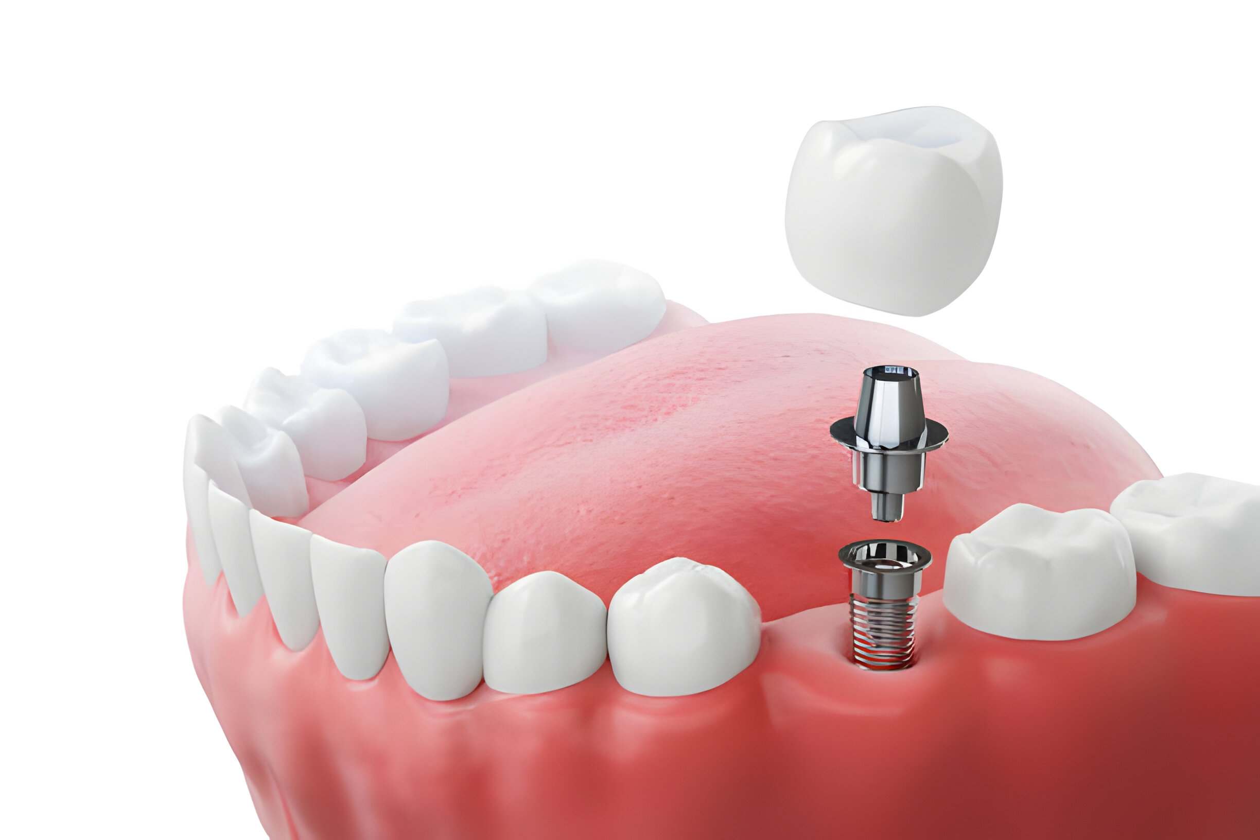 Dental Implants Aftercare: Tips for a Successful Recovery_FI