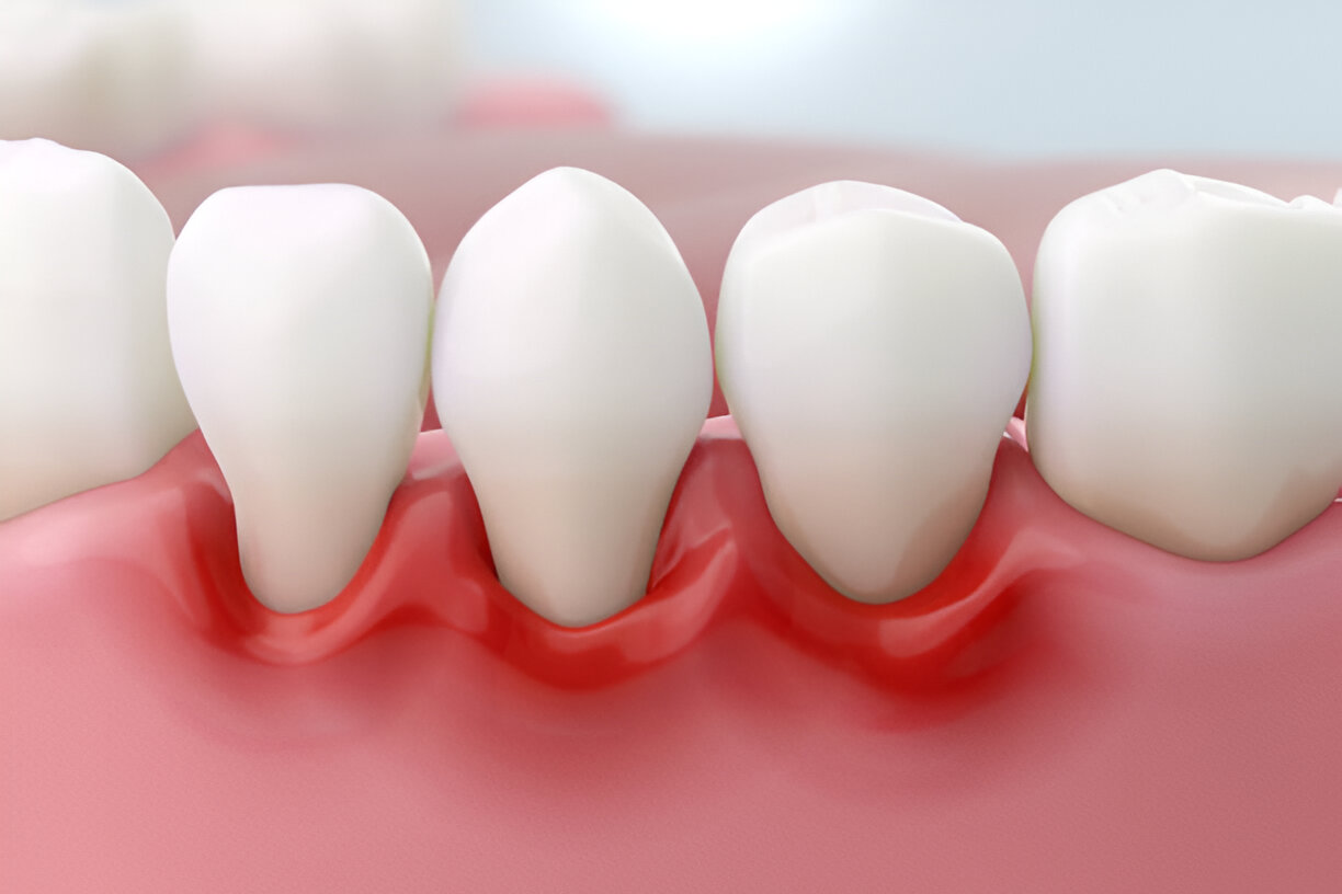 The Benefits of Sundance Dental Grants for Gum Disease Treatment_1
