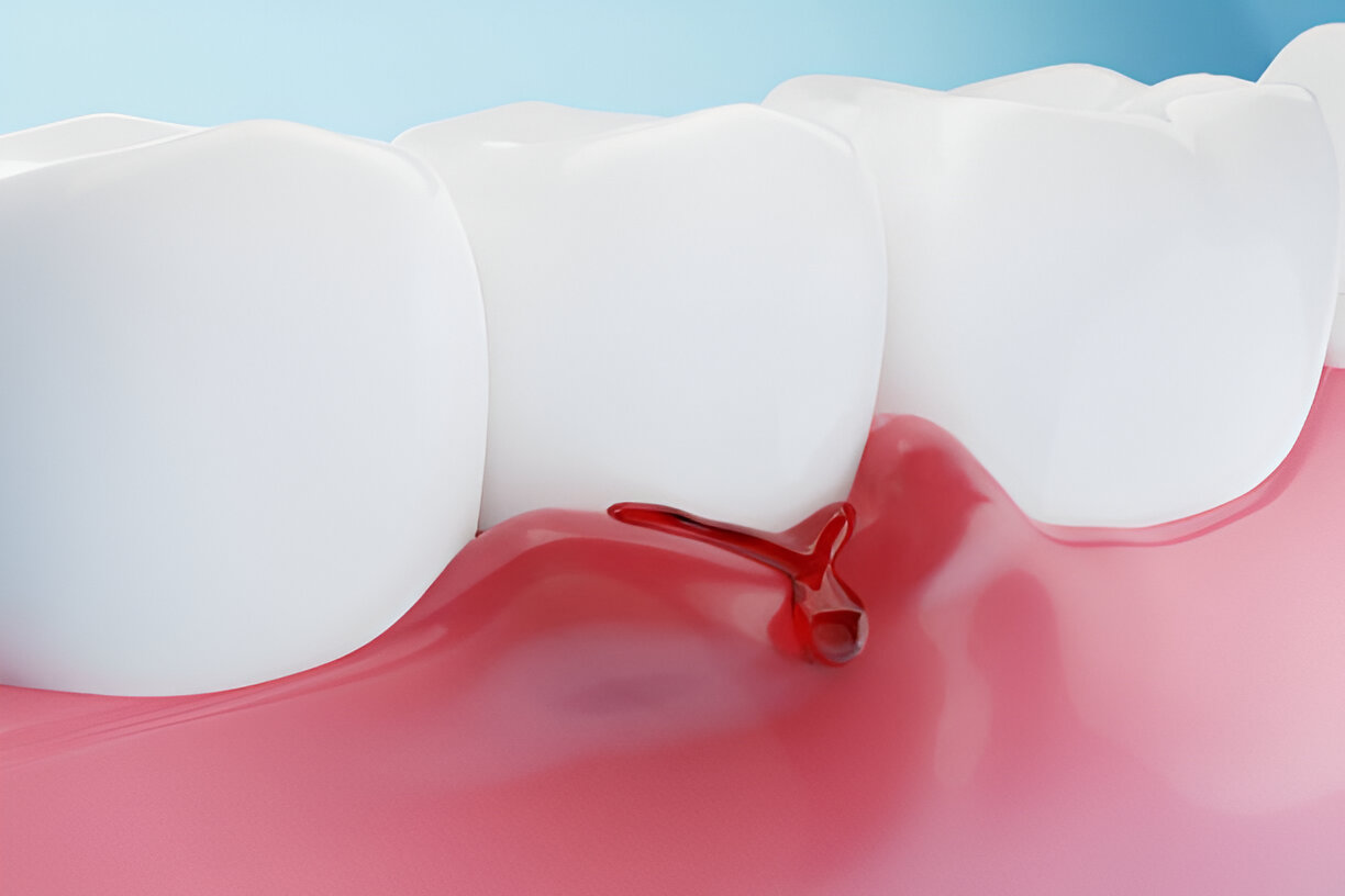 The Benefits of Sundance Dental Grants for Gum Disease Treatment_3