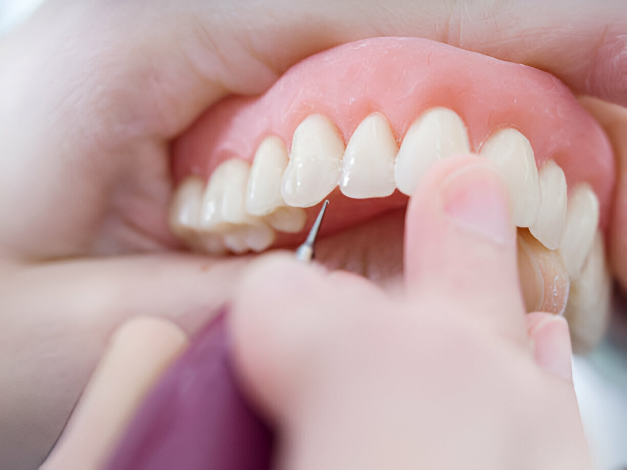 Sundance Dental Bloomfield : The Benefits of Getting Dentures from a Trusted Dentist in Bloomfield_2