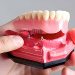Sundance Dental Bloomfield : The Benefits of Getting Dentures from a Trusted Dentist in Bloomfield_FI