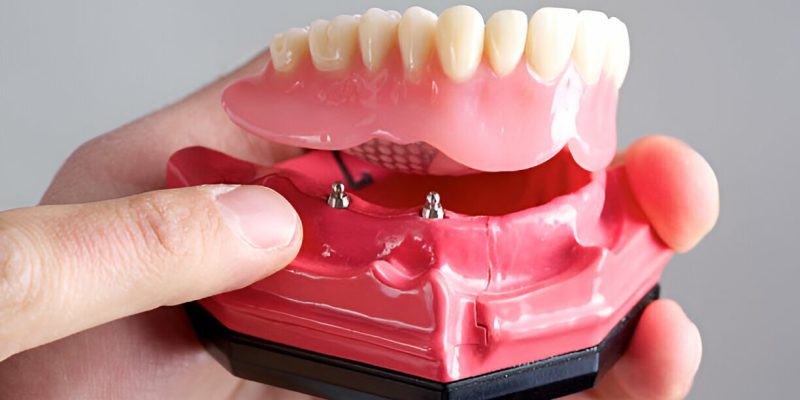 Sundance Dental Bloomfield : The Benefits of Getting Dentures from a Trusted Dentist in Bloomfield_FI