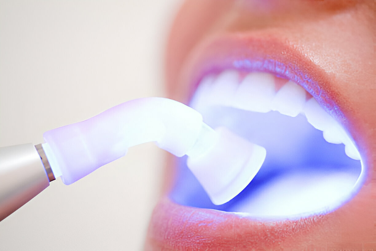 Why Choose Sundance of Gallup for Professional Teeth Whitening in New Mexico?_1