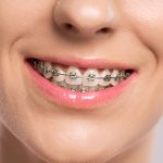 Clearing Misconceptions About Metal Braces What in Gallup, NM Patients Need to Know