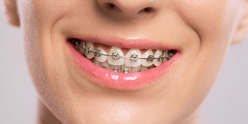 Clearing Misconceptions About Metal Braces What in Gallup, NM Patients Need to Know