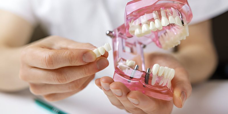 Understanding the Dental Implant Process: What to Expect at Sundance Smiles