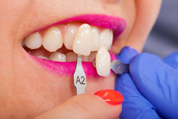 A Complete Guide to Porcelain Veneers for Gallup, NM Patients